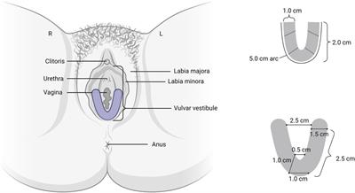 Preferred physical characteristics of lidocaine thin film for women with vestibulodynia